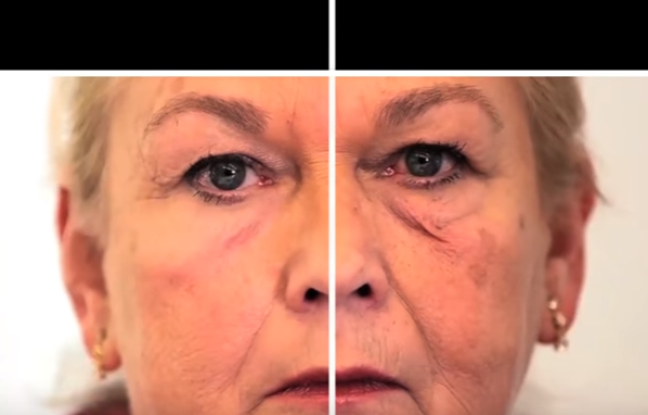 Les compresses du psoriasis