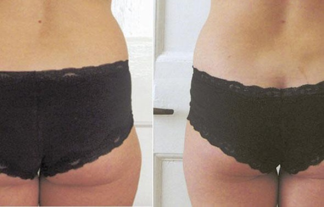 Une nouvelle technique d'amincissement rapide et sans douleur débarque en France. La machine s'appelle LaserLipo. Une nouvelle technique d'amincissement rapide et sans douleur débarque en France. La machine s'appelle LaserLipo.