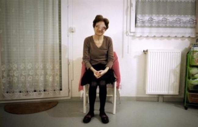 L'esthesioneuroblastome ou neuroblastome olfactif, dont souffrait Chantal Sébire retrouvée morte mercredi soir à son domicile, est une tumeur très rare dont moins de mille cas ont été rapportés dans la littérature médicale ces vingt dernière années. L'esthesioneuroblastome ou neuroblastome olfactif, dont souffrait Chantal Sébire retrouvée morte mercredi soir à son domicile, est une tumeur très rare dont moins de mille cas ont été rapportés dans la littérature médicale ces vingt dernière années.