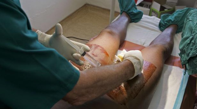 Le schéma de lopération de laugmentation du membre