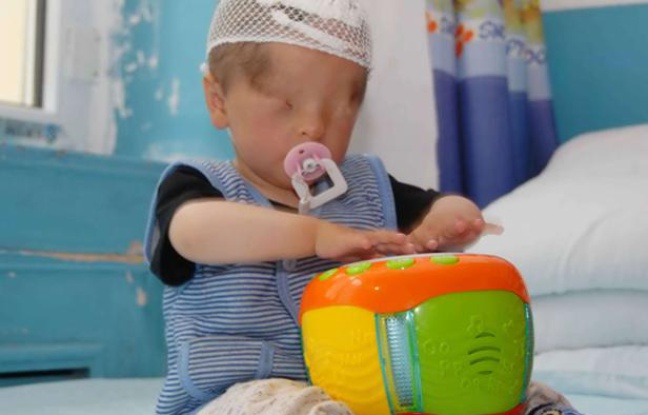 Marwanijung, un bébé chinois né avec de la peau sur les yeux, le 6 juin 2012, à Urumqi (Chine). Marwanijung, un bébé chinois né avec de la peau sur les yeux, le 6 juin 2012, à Urumqi (Chine).