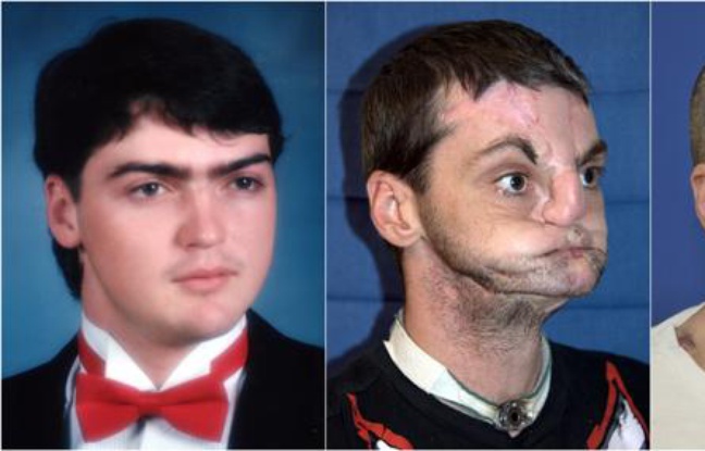 Richard Norris, avant le coup de feu qui l'a défiguré, et après sa greffe du visage en mars 2012.
Richard Norris, avant le coup de feu qui l'a défiguré, et après sa greffe du visage en mars 2012.