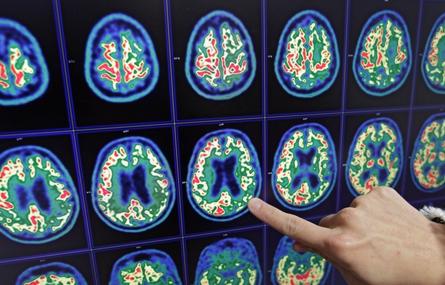Tep Scan du cerveau d'un patient atteint de la maladie d'Alzheimer. Tep Scan du cerveau d'un patient atteint de la maladie d'Alzheimer.