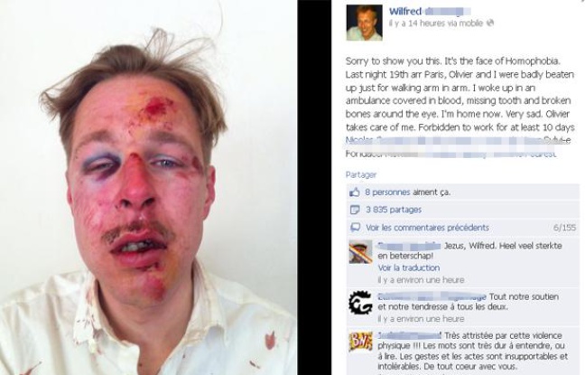 La photo du visage de Wilfred, publiée sur Facebook le lendemain de l'agression dont il a été victime avec son compagnon, dans la nuit du samedi 6 au dimanche 7 avril à Paris La photo du visage de Wilfred, publiée sur Facebook le lendemain de l'agression dont il a été victime avec son compagnon, dans la nuit du samedi 6 au dimanche 7 avril à Paris