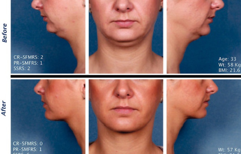 injection double menton