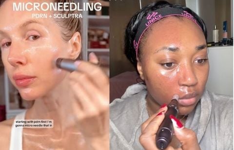 Ça vaut quoi le microneedling, qui perfore la peau pour la régénérer ?