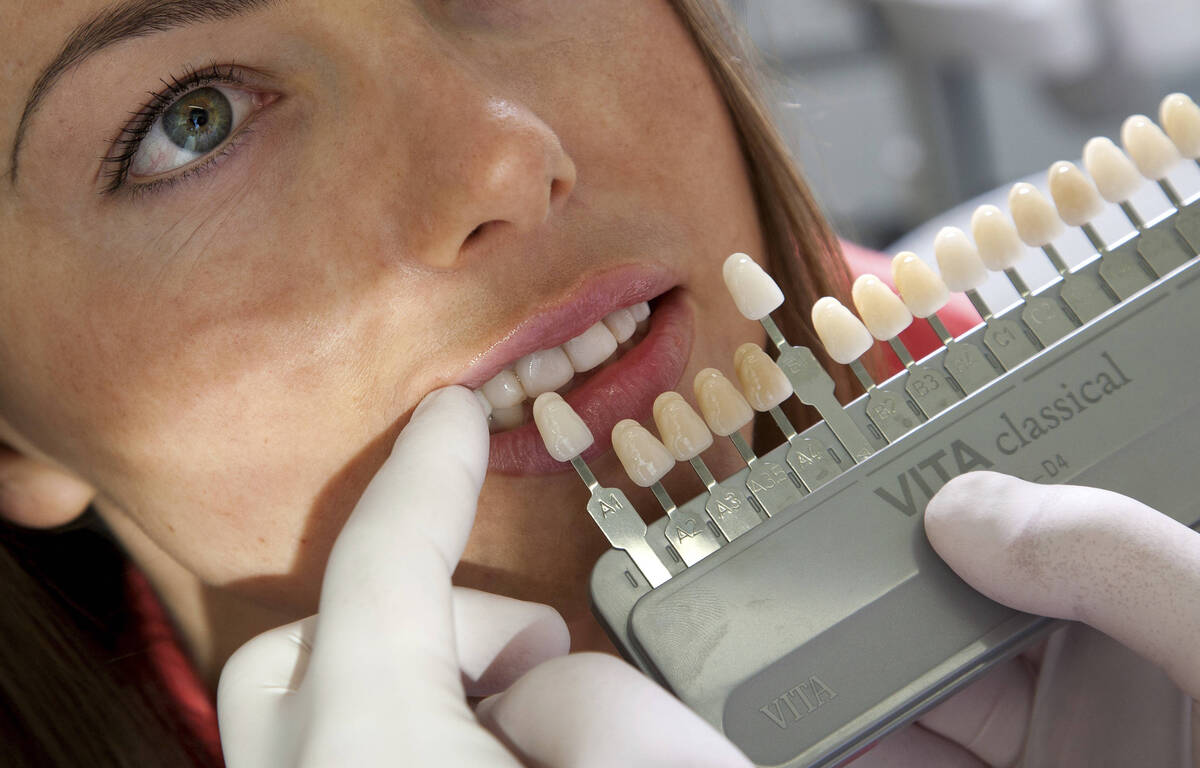 Facette Sans Limer Les Dents Turquie Sourire ultra bright : Pour des facettes, faut-il un limage en dents de  requin, comme le clament les influenceurs de TikTok ?