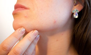 Une équipe de chercheurs a mis au point un vaccin contre l'acné, mais il n'a pas encore atteint la phase de tests sur l'homme.