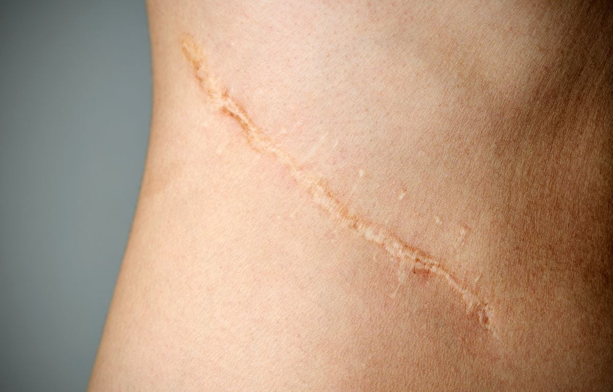 Comment désinfecter une plaie ou blessure ? - Conseil santé