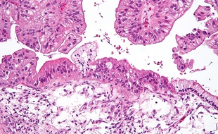 Une tumeur ovarienne vue au microscope.