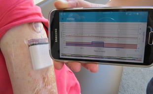 Avec Diabeloop, le smarphone calcule en permanence les doses d'insuline à injecter et transmet les information à la pompe.