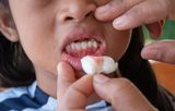 Pourquoi le scorbut est-il de retour chez les enfants en France ?