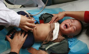 Un bébé est ausculté pour vérifier s'il ne souffre pas de défaillance rénale après avoir consommé du lait frelaté, dans un hôpital du Sichuan en Chine, le 17 septembre 2008