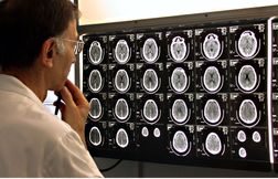 Un homme dépressif depuis 30 ans va mieux grâce à un implant cérébral