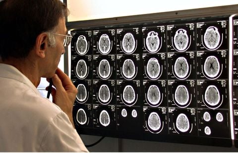 Un homme dépressif depuis 30 ans va mieux grâce à un implant cérébral