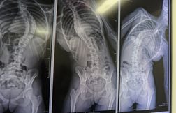 Une jeune britannique opérée avec succès en Chine pour une double scoliose