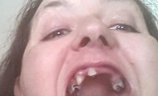 dents pourries homme,dents pourries reve,dents pourries filles,dents pourries bebe,dents pourries drogue,dents pourries chat,dents pourries par le sucre,dents pourries de deschamps,dents pourries photos,dents pourries que faire,