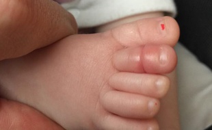 L'orteil de Molly, une petite fille de 4 mois, victime du syndrome du tourniquet.