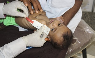 Un enfant souffrant de sous-nutrition.