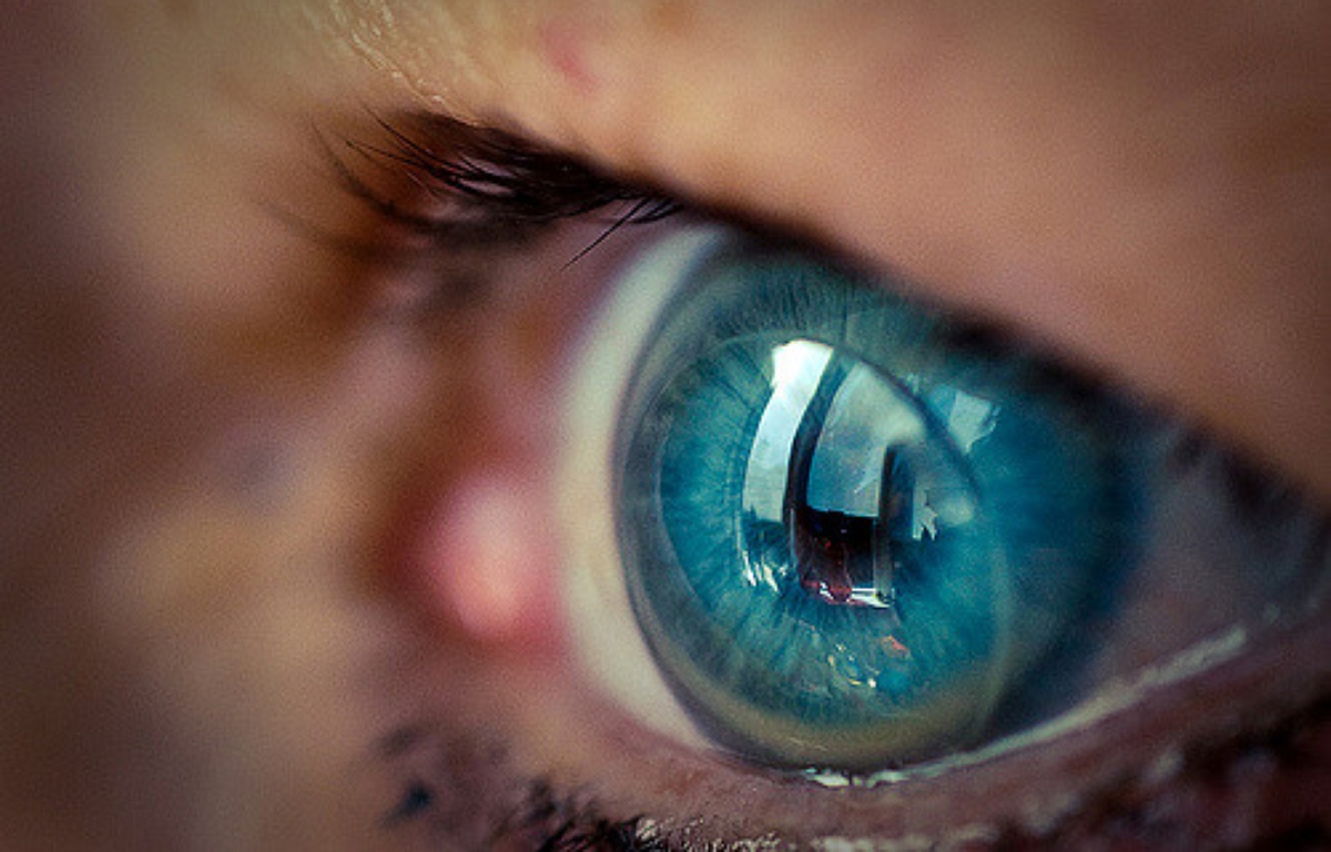 RoyaumeUni La patiente vivait avec 27 lentilles de contact agglomérées dans son oeil
