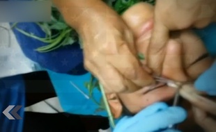 Les médecins lui extraient un ver de l'oeil.