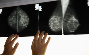 Ilustration d'une radiographie des seins.