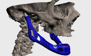 Des chercheurs de l'université d'Hasselt ont implanté avec succès la première mâchoire «imprimée ne 3D».