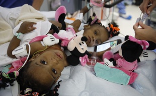 Bissie et Eyenga, deux petites sœurs siamoises, ont été opérées avec succès le mercredi13 novembre à Lyon.