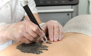 Le détatouage pratiqué à l'aide d'un appareil Irisiôme se fait en quelques séances, promises sans douleur.