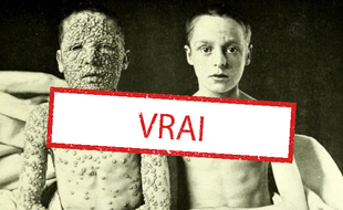 Cette photo montrant deux enfants de 13 ans atteints de la variole est authentique