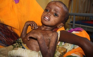 Un enfant souffrant de malnutrition à l'hôpital Banadir de Mogadiscio, le 15 juillet 2014 en Somalie