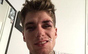 Le visage tuméfié, Clément dénonce avec le sourire la violente agression homophobe dont il vient d'être victime
