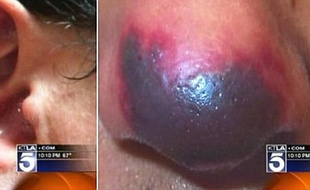 Des patients victimes de nécrose cutanée après avoir consommé de la cocaïne coupée au levamisole.