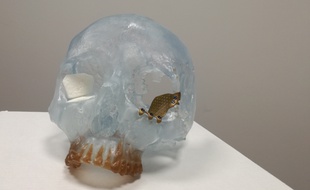 Villeurbanne, le 6 décembre 2018. Une prothèse 3D en titane a été créée à Lyon pour permettre de reconstruire les orbites osseuses en chirurgie maxillo-faciale.