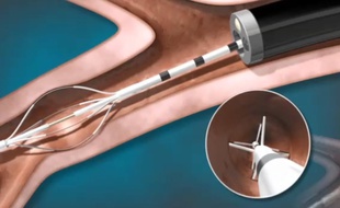 Dispositif inséré dans les bronches à l'aide d'un bronchoscope flexible.