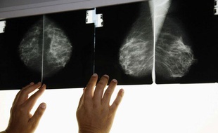 Une radio effectuée dans le cadre d'une mammographie pour dépister le cancer du sein.