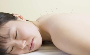 Acupuncture, illustration.