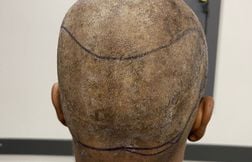 Un Britannique meurt après s’être rendu en Turquie pour une greffe de cheveux