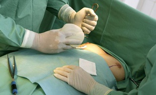Un chirurgien met en place des implants mammaires à une patiente.
