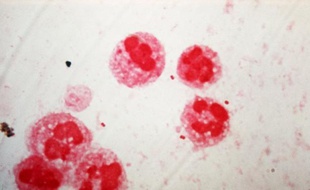 Un adolescent de 16 ans est décédé jeudi en Saône-et-Loire d'une infection invasive à méningocoque (IMM), a annoncé vendredi l'Agence régionale de santé (ARS) de Bourgogne, qui a en outre signalé une suspicion d'infection concernant une jeune fille, hospitalisée.