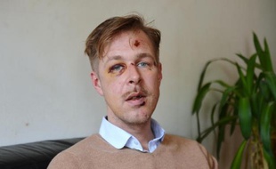 Wilfred de Bruijn, blessé et le visage tuméfié, à la suite d'une agression homophobe dont il a été victime, avec son ami Olivier, le 11 avril 2013 dans le XIXe arrondissement de Paris