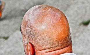 Illustration d'un homme chauve.
