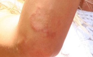 Illustration du psoriasis.