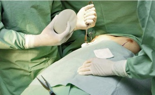 En cas de rupture d'une prothèse, les patientes devront subir une nouvelle opération.