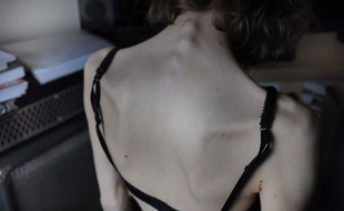 Selon une étude de l'Inserm, l'anorexie mentale ne s'expliquerait pas par une peur de prendre du poids, mais par le plaisir d'en perdre.