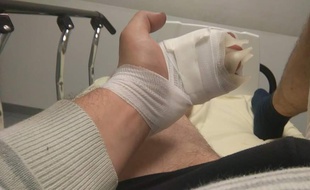 Cédric B. a les mains brûlées au deuxième degré après l'explosion de la batterie de sa cigarette électronique.