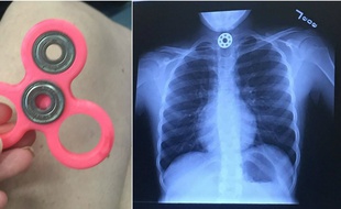 L'anneau en métal s'est logé dans l'oesophage de la fillette.