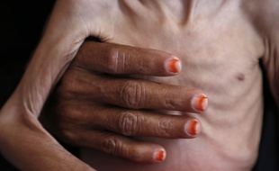 Un enfant dénutri au Yémen.