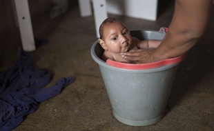 Un bébé atteint de microcéphalie au Brésil à cause du virus Zika.