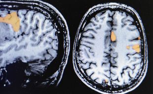Illustration d'une tumeur du cerveau.